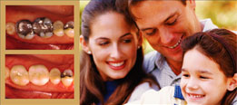 Replace unsightly silver fillings with natural-looking CEREC restorations